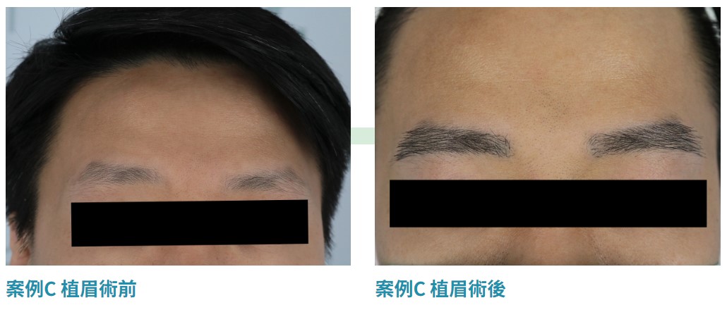 DCDC專業植眉手術案例C